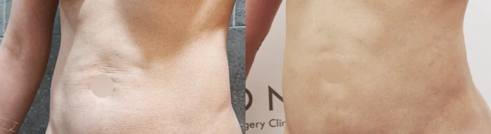 체형성형센터 시술 전후 사진 18 · 보니따의원