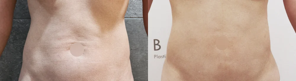 리뉴비온 라인리프팅 시술 전후 사진 4 · 보니따의원