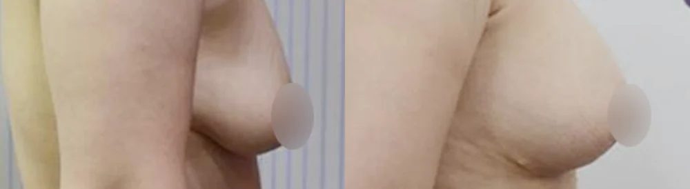 세이프 가슴성형 시술 전후 사진 12 · 보니따의원