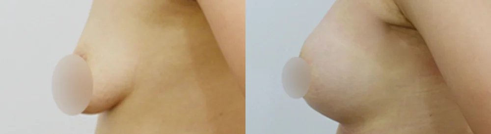 세이프 가슴성형 시술 전후 사진 17 · 보니따의원