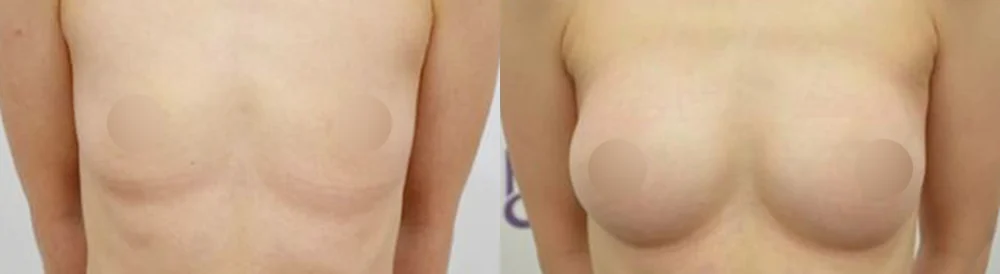 세이프 가슴성형 시술 전후 사진 26 · 보니따의원