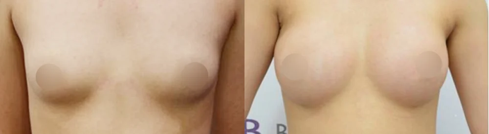 세이프 가슴성형 시술 전후 사진 27 · 보니따의원