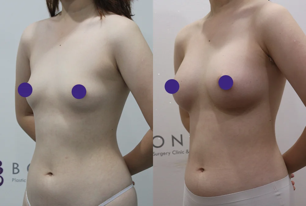 가슴 보형물은 얼마나 안전하고, 지방이식과는 무엇이 다를까요? · 전후 사진 1