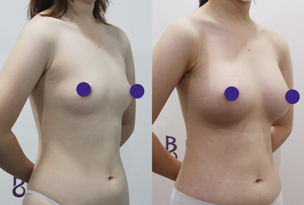가슴 보형물은 얼마나 안전하고, 지방이식과는 무엇이 다를까요? · 전후 사진 2