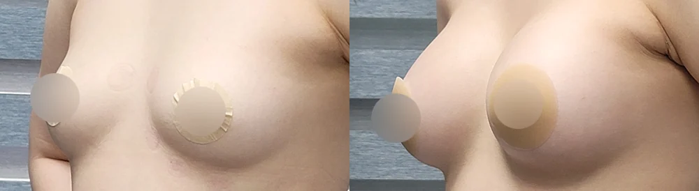 세이프 가슴성형 시술 전후 사진 37 · 보니따의원