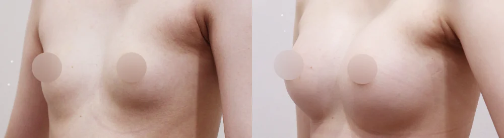 세이프 가슴성형 시술 전후 사진 38 · 보니따의원