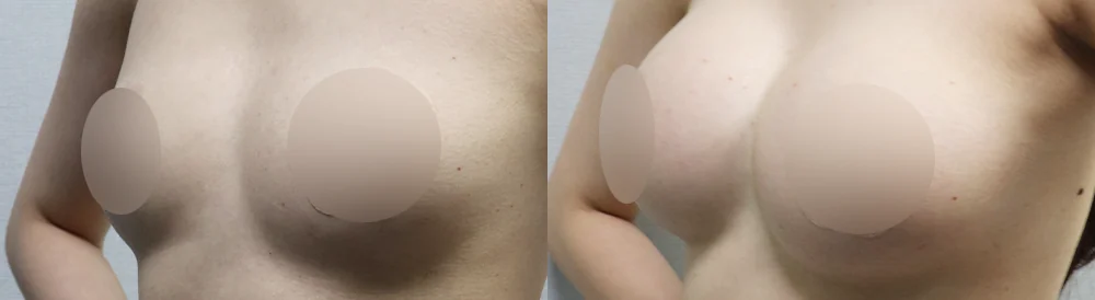 세이프 가슴성형 시술 전후 사진 40 · 보니따의원