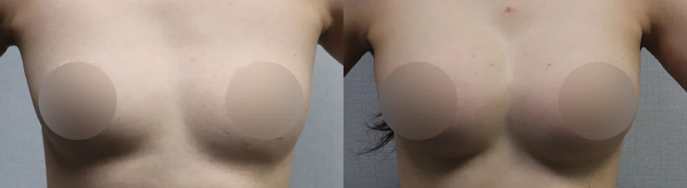 세이프 가슴성형 시술 전후 사진 41 · 보니따의원