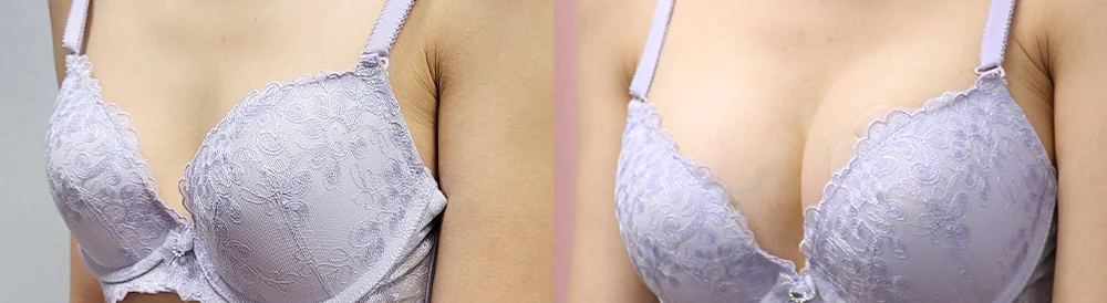 세이프 가슴성형 시술 전후 사진 44 · 보니따의원