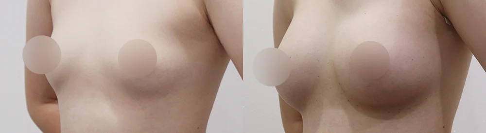세이프 가슴성형 시술 전후 사진 46 · 보니따의원