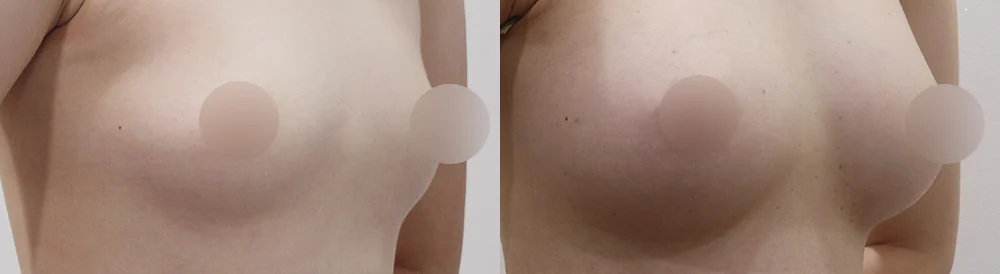 세이프 가슴성형 시술 전후 사진 47 · 보니따의원