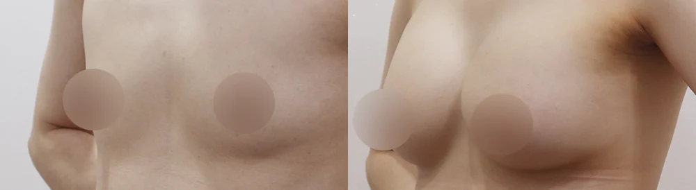 세이프 가슴성형 시술 전후 사진 52 · 보니따의원