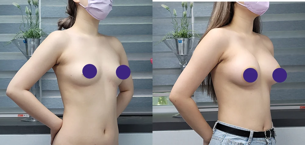 세이프 가슴성형 시술 전후 사진 6 · 보니따의원