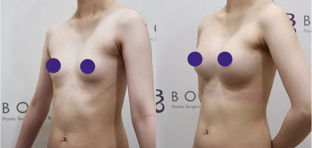 세이프 가슴성형 시술 전후 사진 7 · 보니따의원