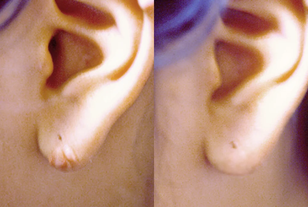 Sebaceous Cyst and Lipoma Removal in Seoul: Why the Sac Matters and When to Remove a Lump · Before and after 2