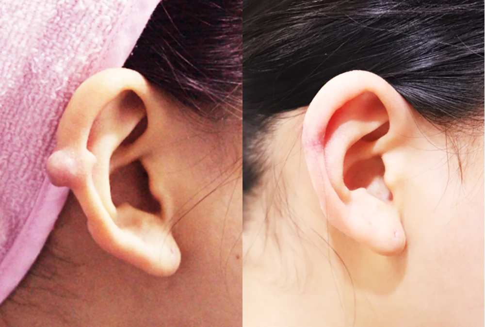 Sebaceous Cyst and Lipoma Removal in Seoul: Why the Sac Matters and When to Remove a Lump · Before and after 1