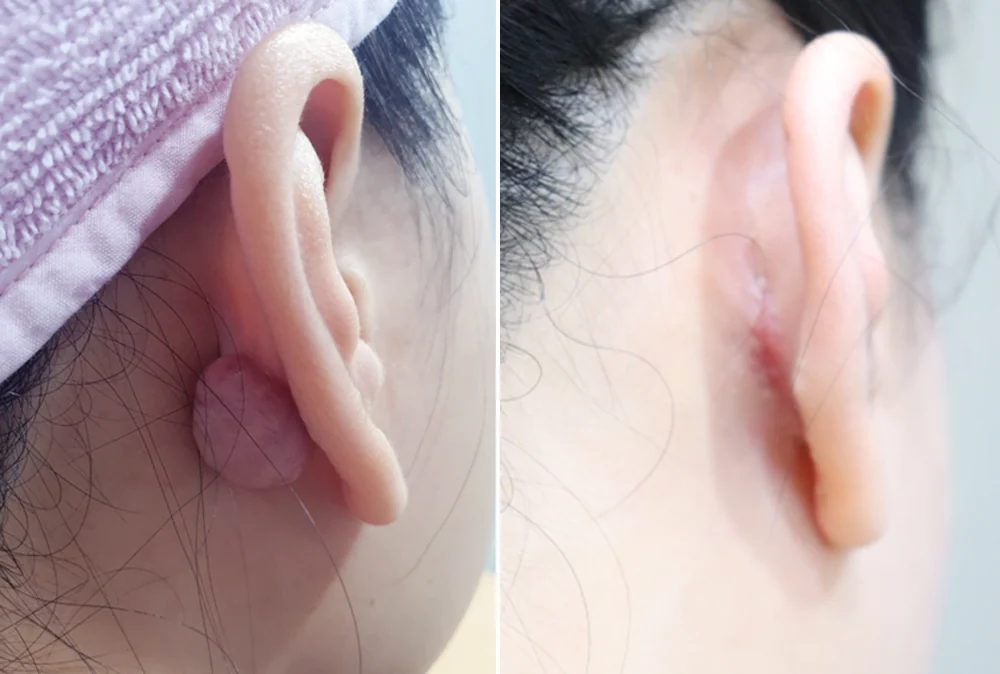 Sebaceous Cyst and Lipoma Removal in Seoul: Why the Sac Matters and When to Remove a Lump · Before and after 3