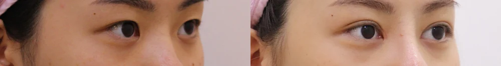 상안검 시술 전후 사진 5 · 보니따의원