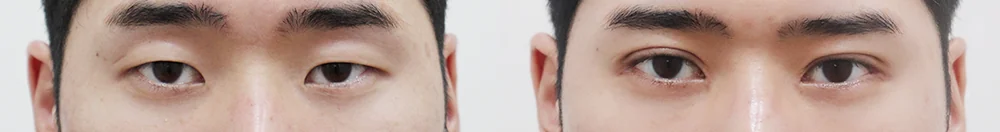 상안검 시술 전후 사진 6 · 보니따의원