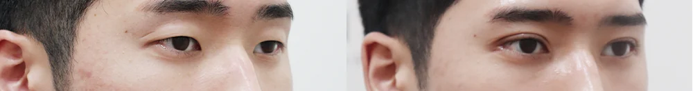 상안검 시술 전후 사진 7 · 보니따의원