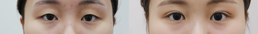 상안검 시술 전후 사진 8 · 보니따의원