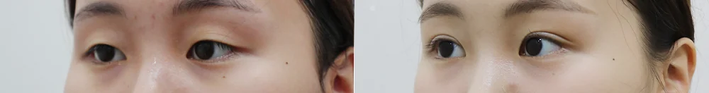 상안검 시술 전후 사진 9 · 보니따의원