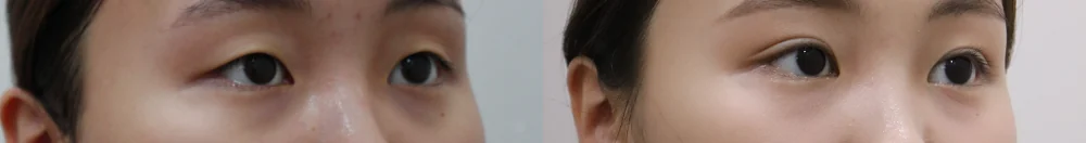 상안검 시술 전후 사진 10 · 보니따의원