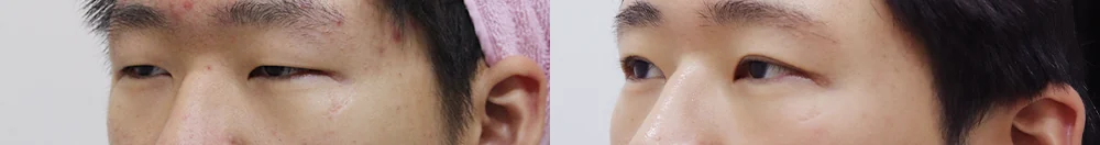 상안검 시술 전후 사진 13 · 보니따의원