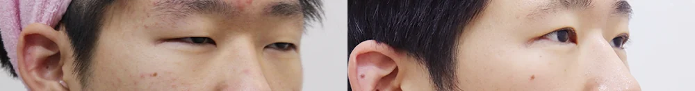 상안검 시술 전후 사진 14 · 보니따의원