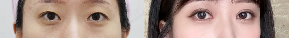 상안검 시술 전후 사진 15 · 보니따의원