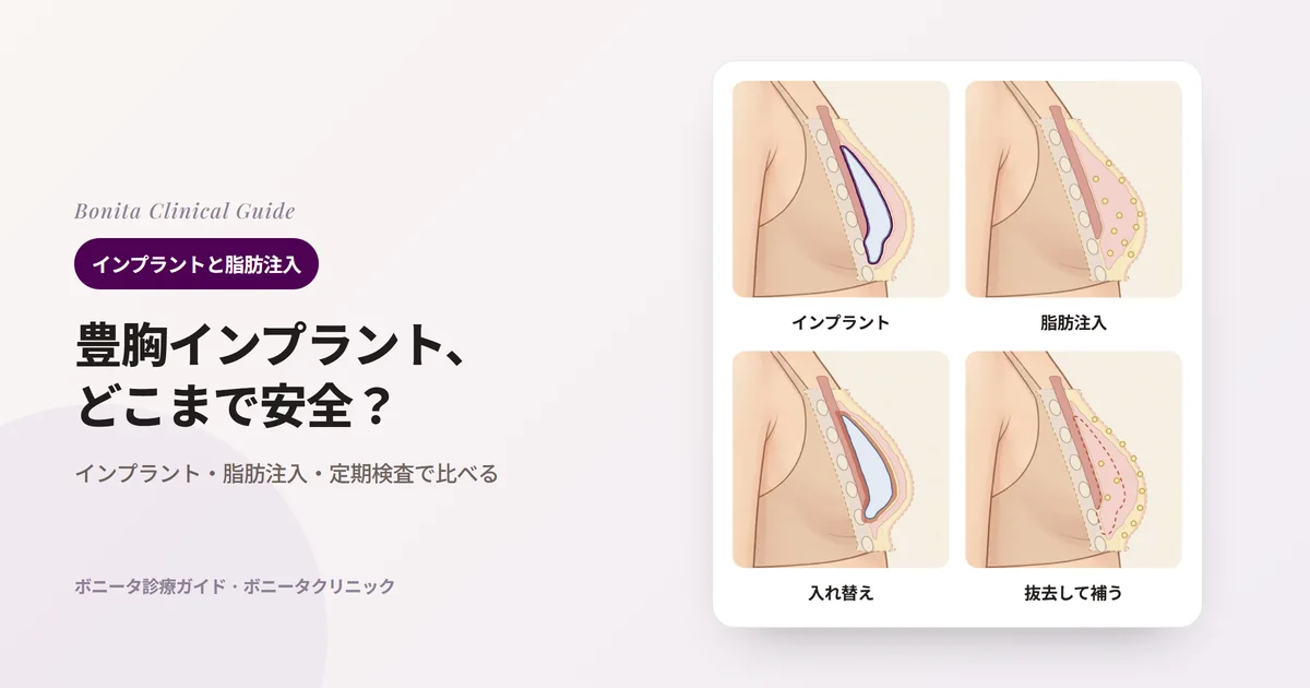乳房を横から切った断面4枚：乳腺下に入ったインプラントと被膜、乳房の組織の間に少しずつ入れた脂肪、厚くなった被膜に押されたインプラント、インプラントを抜いた後の空間と皮下に入れた脂肪。それぞれ検討される場面と知っておきたい点を書いたカード