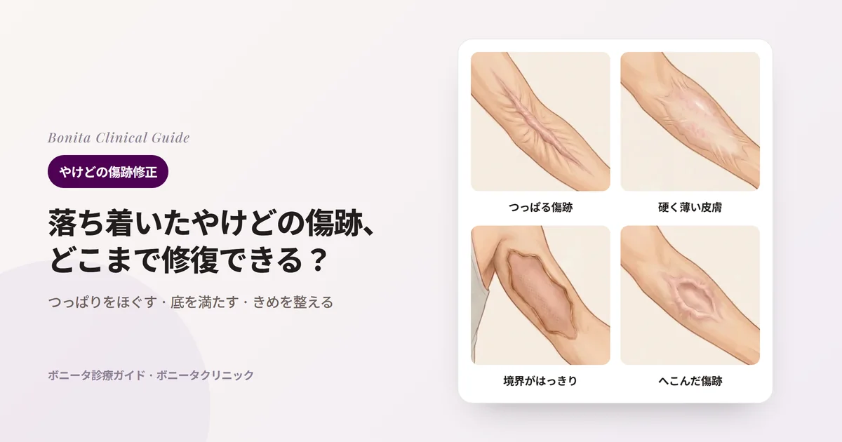 腕のイラスト4枚に、ひじの内側を横切ってつっぱる厚い傷跡の帯、前腕の硬く薄くなった傷跡の皮膚、上腕の境界がはっきりした広い傷跡、前腕のへこんだ傷跡をそれぞれ描き、ボニータクリニックの方法を書いたカード