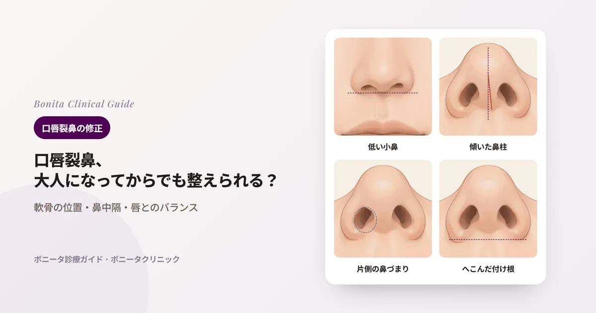 同じ人の鼻を描いたカード四枚：正面から見た片側の低く広い小鼻、下から見た傾いた鼻柱、平たく狭くなった裂側の鼻の穴、後ろへ下がった裂側の小鼻の付け根
