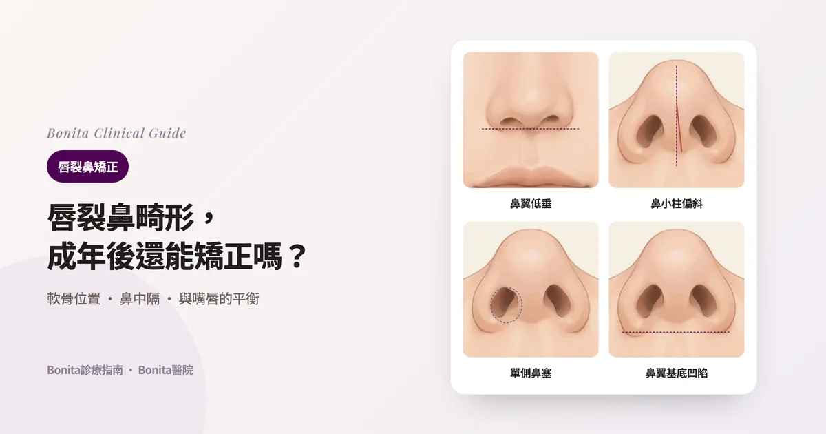 以同一個人的鼻子繪製的四張卡片：正面看一側鼻翼低而寬，從下方看鼻小柱偏斜、患側鼻孔變扁變窄、患側鼻翼基底往後退