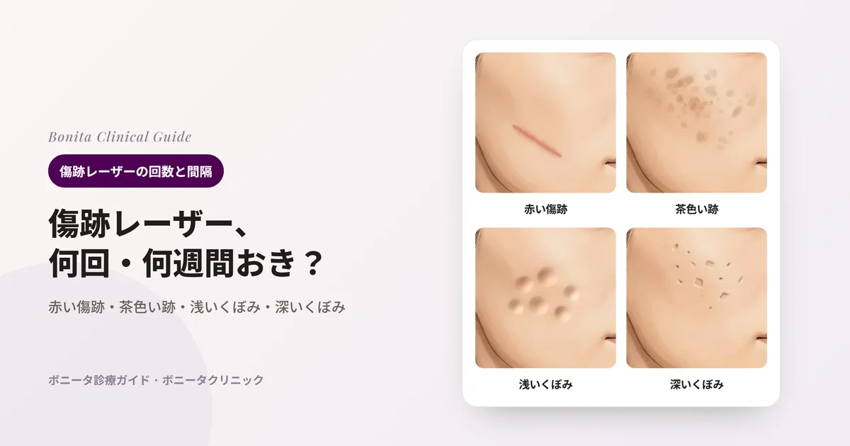 同じ人の頬を描いたイラスト4枚：赤い線状の傷跡、茶色い跡、浅く広いくぼみ、狭く深いくぼみ。カードごとに主に検討するレーザーや方法を記載。