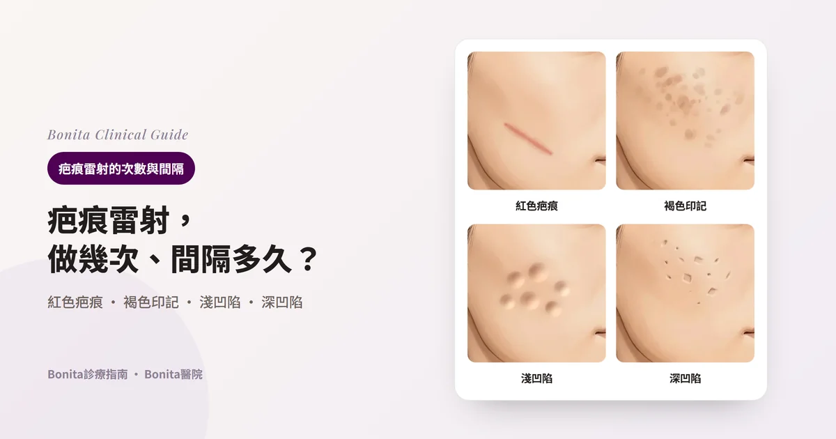 同一人臉頰的四張插圖:紅色線狀疤痕、褐色印記、淺而寬的凹陷、窄而深的凹陷。每張卡片註明主要考慮的雷射或方法。