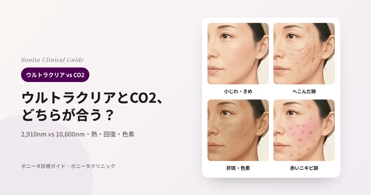 同じ女性の斜め横顔のイラスト4枚：目もとの小じわと肌のきめの粗さ、頬の深いニキビ跡、頬骨の上の肝斑とやや濃い肌色、頬の赤いニキビ跡をそれぞれ示し、先に検討するレーザーを記したカード